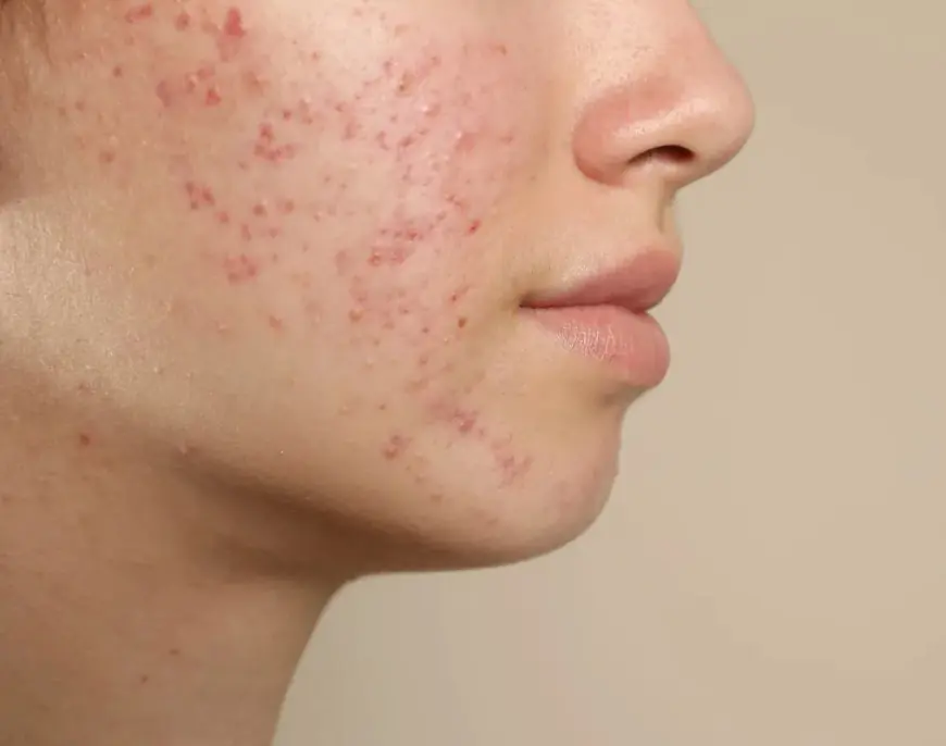 Understanding Acne: The Best Treatments Based on Your Skin Type