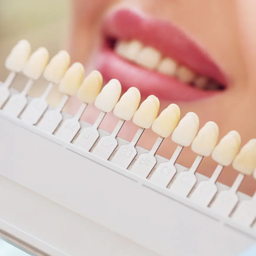 Exploring the Reasons Dental Veneers Are Ideal for Smile Perfection