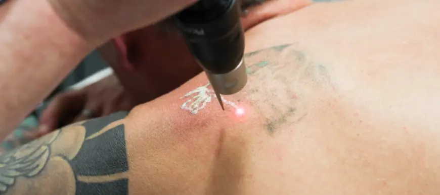 How to Ensure the Best Results with Your Laser Tattoo Removal Sessions