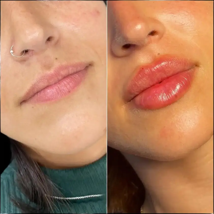 Lip Augmentation by Best Plastic Surgeons in Dubai