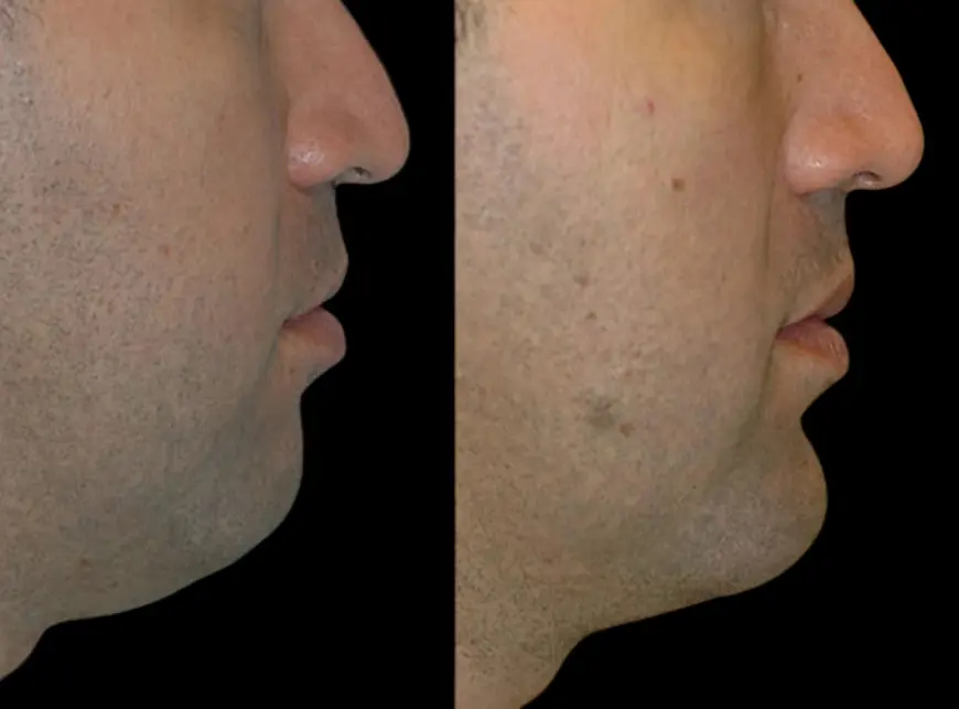 Non-Surgical Solutions: Chin Fillers Treatment in Dubai