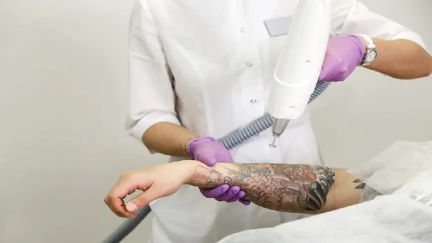 The Long-Term Benefits of Laser Tattoo Removal in Dubai