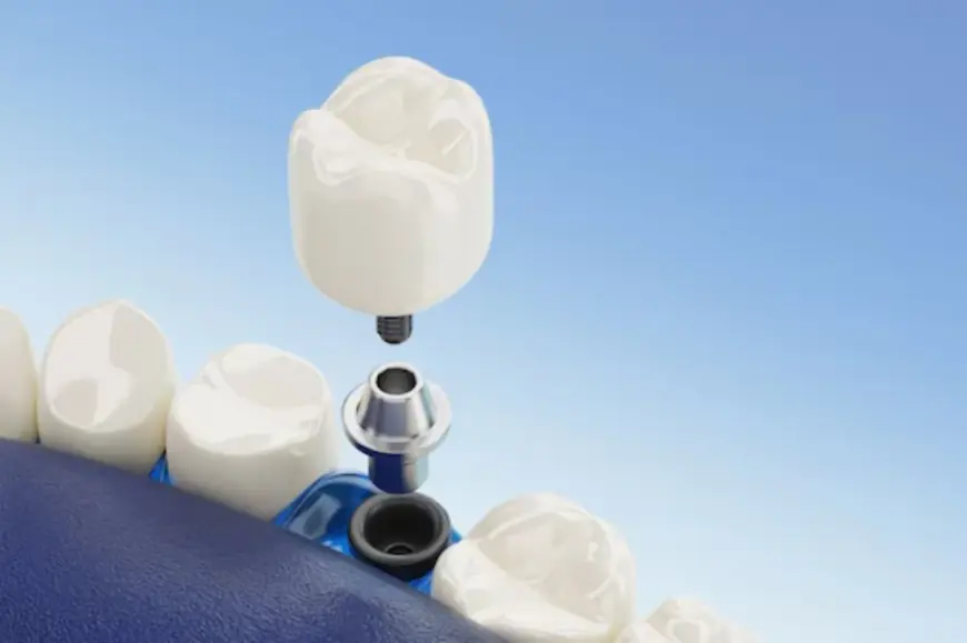 Dental Implants: A Lasting Solution for Your Smile in SW Calgary