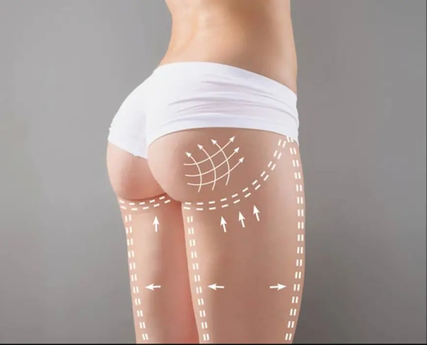 Is Dubai the Best Place for Butt Filler Injections?