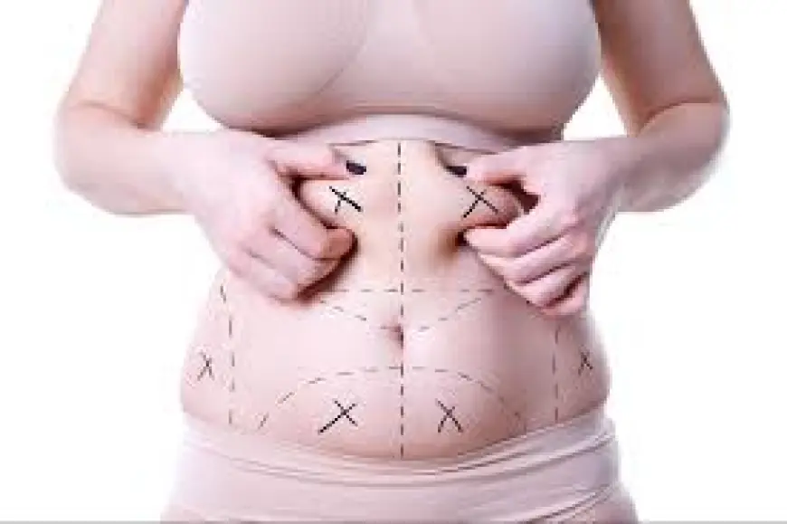 Liposuction in Islamabad: Achieve Your Dream Body with Precision and Care