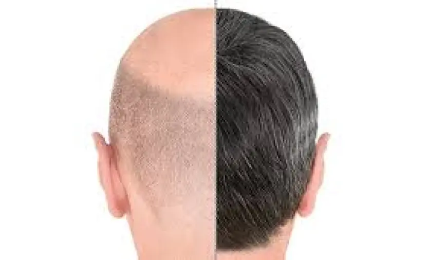 Hair Transplant in Dubai: A Comprehensive Guide