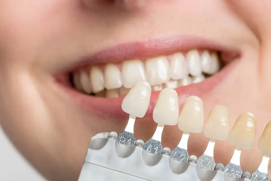 How to Care for Your Dental Veneers After Getting Them