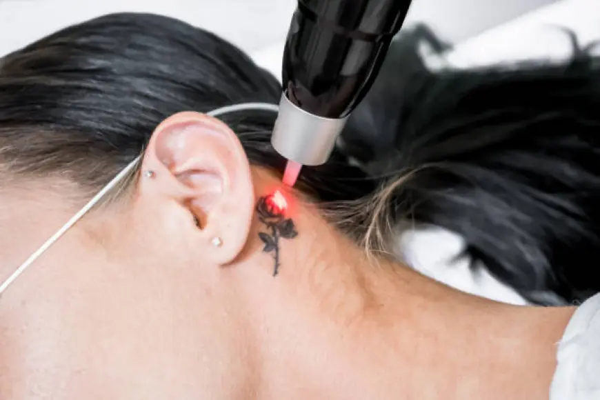 Remove or Fade? Best Options for Tattoo Removal in Dubai