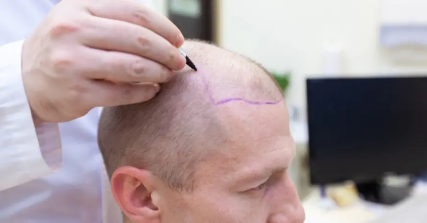 Top 10 Things to Know About Hair Transplants