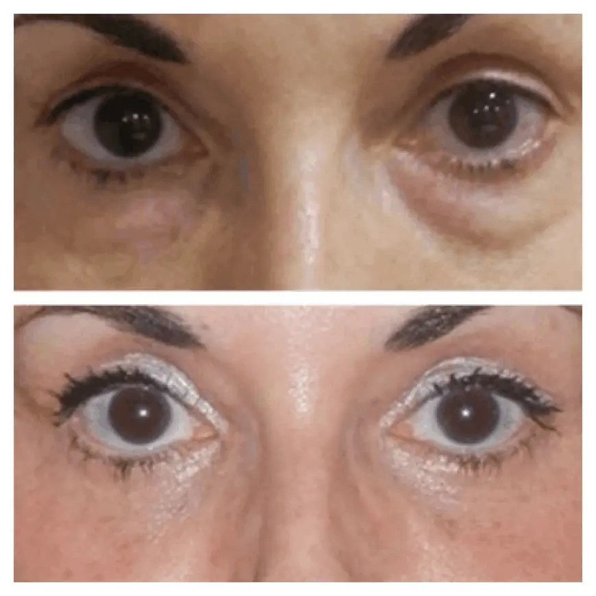 Why the Best Eye bag removal Surgeon in dubai is Your Best Option