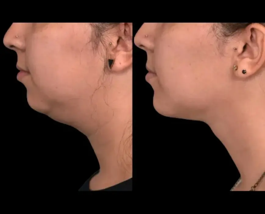 Top Tips for Selecting the Best Double chin removal Surgeon in dubai