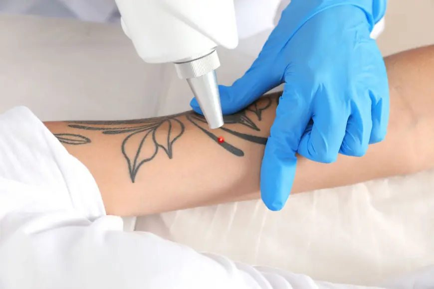 Can All Tattoo Colors Be Removed? Dubai’s Best Skin-Safe Lasers