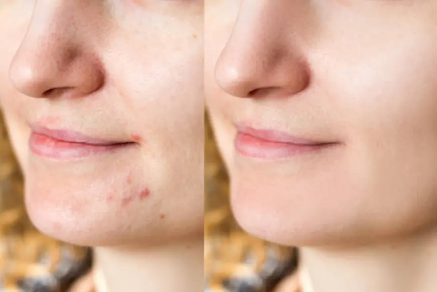 How to Treat Acne While Using Retinol or Other Actives