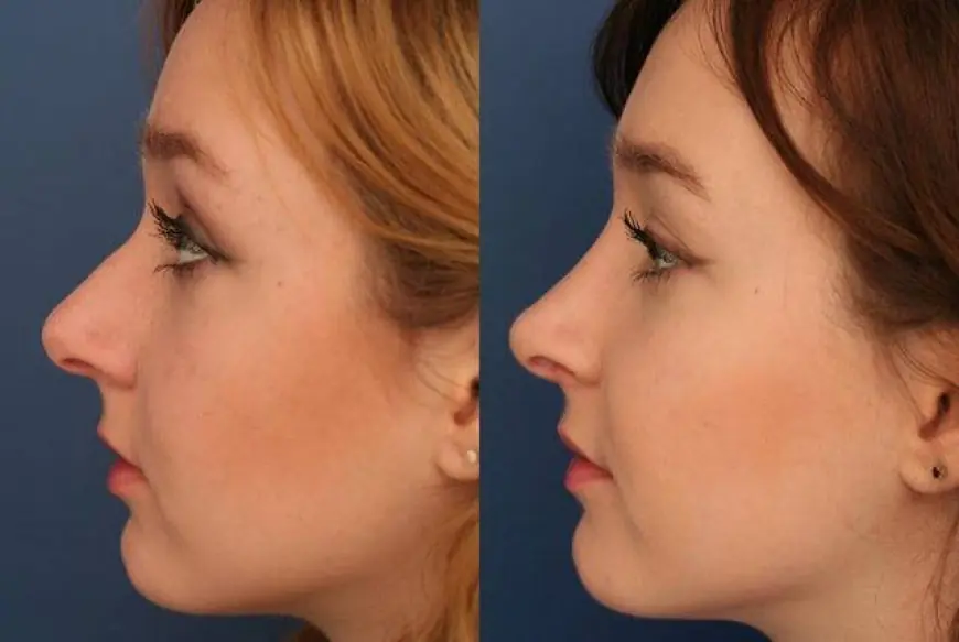 Refine Your Nose and Boost Confidence with Rhinoplasty in Riyadh