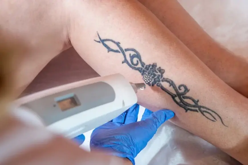 Why Picosure Tattoo Removal Is the Best Choice for You