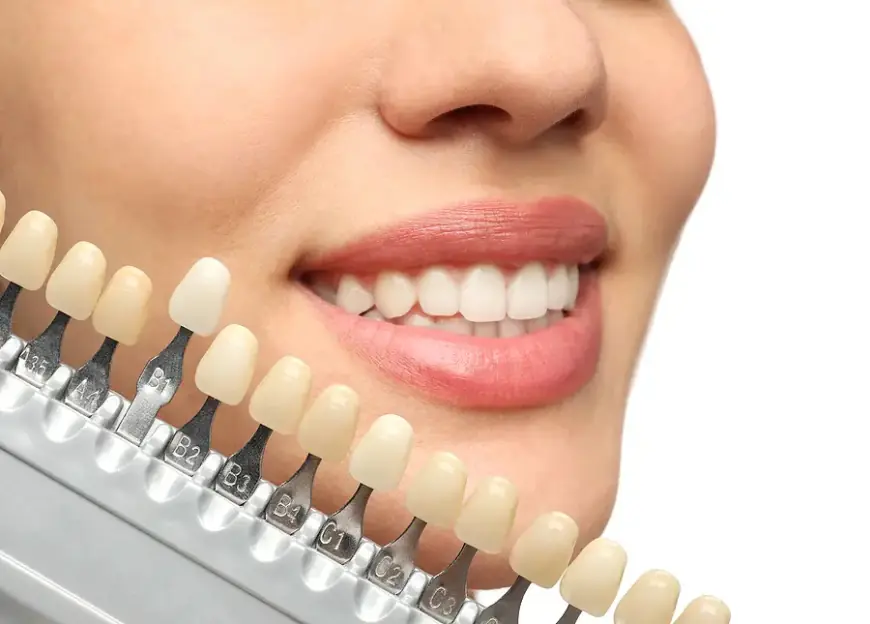 The Importance of Proper Care for Dental Veneers