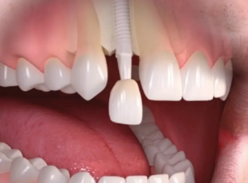 What is the cheapest way to fix your teeth?