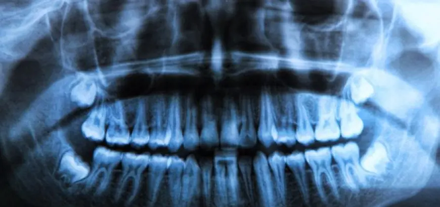 The Importance of Dental X-rays for Your Oral Health