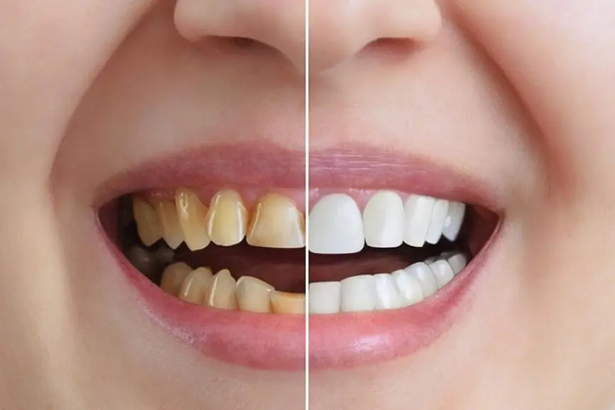 Full Mouth Restoration: How Long Does the Process Take?