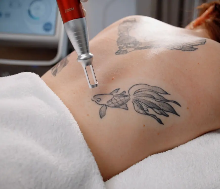 Experience the Advantages of Pico Tattoo Removal Today