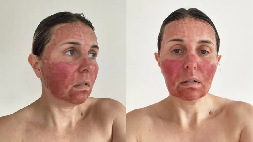 Fractional CO2 Laser: A Modern Solution to Sun Damage and Aging Skin