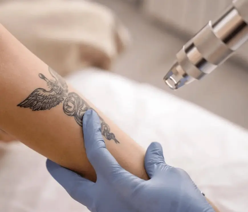 Can Laser Tattoo Removal in Dubai Be Pain-Free? Find Out Here