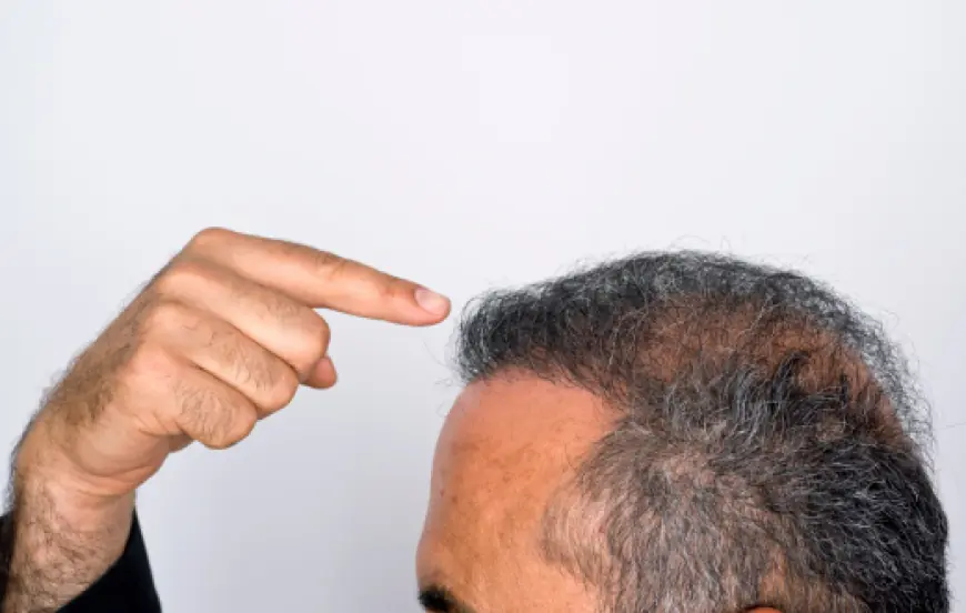 Is Hair Transplant Surgery Worth the Cost?