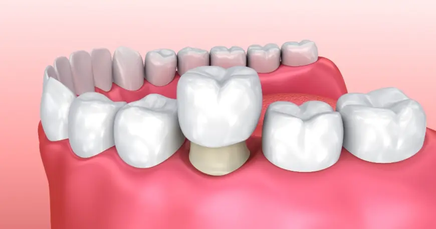 Can You Whiten a Dental Crown? What You Need to Know