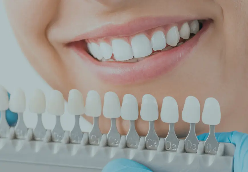 Dental Veneers for Gaps, Chips & Discoloration – A Full Guide