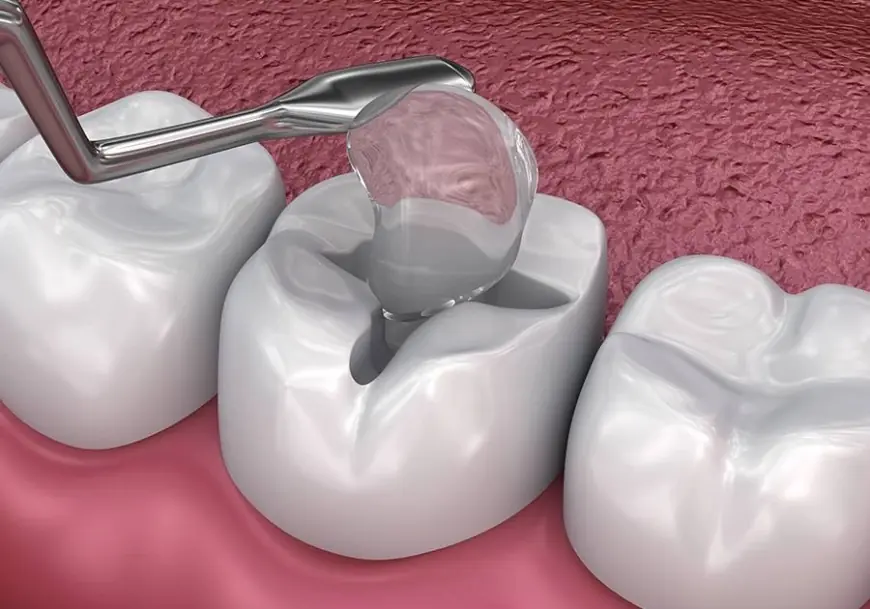 Composite Fillings and Sensitivity: How to Manage It