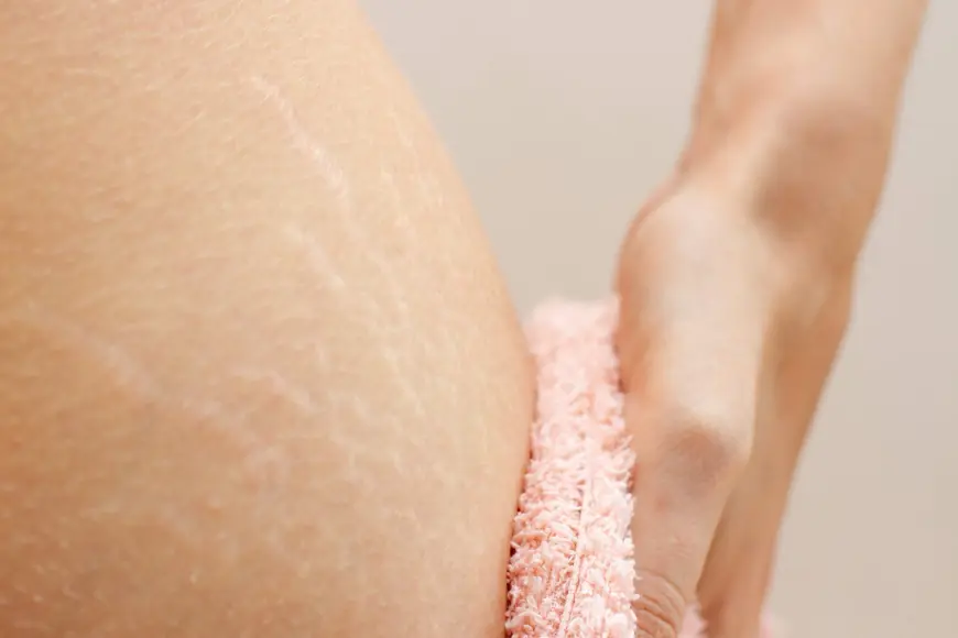 Stretch Marks No More: Laser Solutions That Actually Work