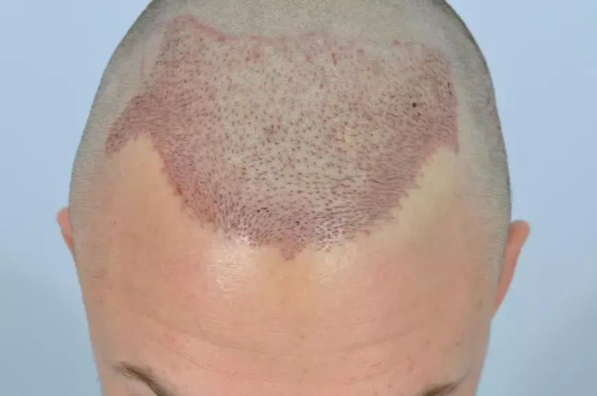 How to Determine if a Hair Transplant is Right for Your Budget