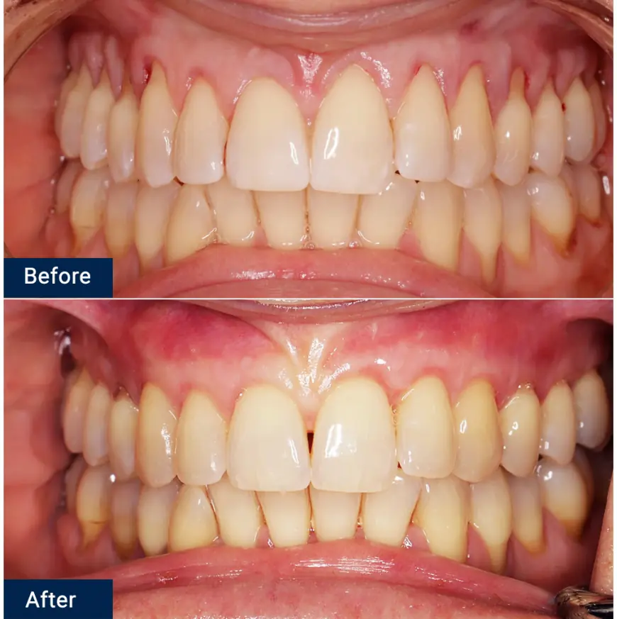 Gum Contouring vs. Gum Grafting: What’s the Right Choice for You?