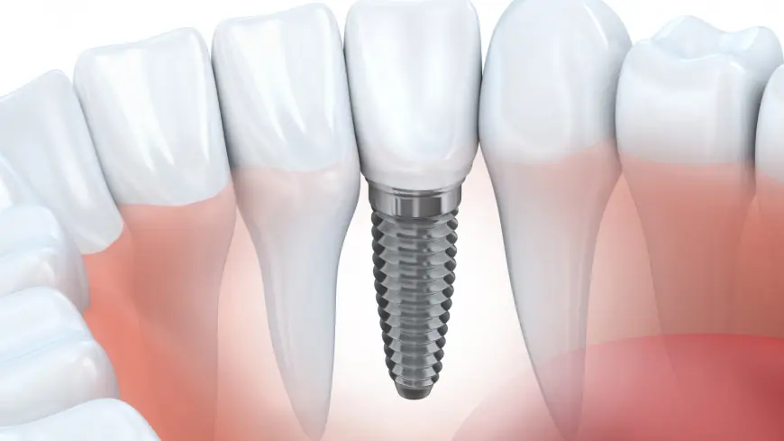 No More Waiting: Why Same-Day Dental Implants Are a Popular Choice