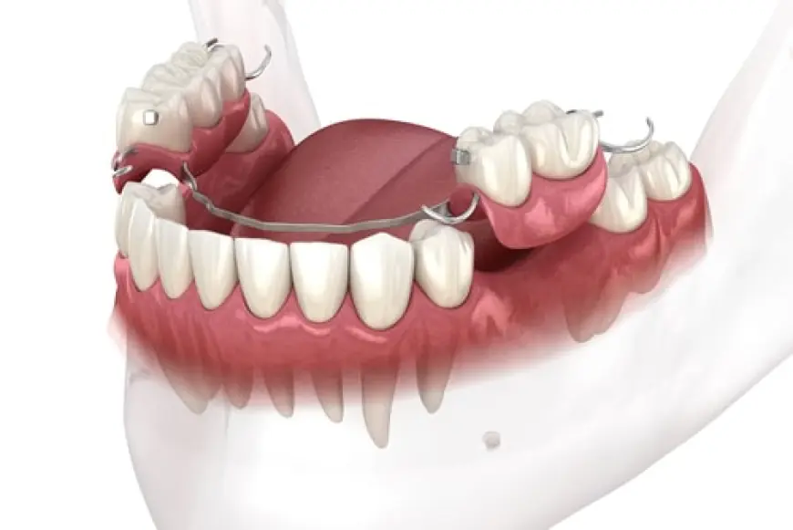 Single Tooth Dentures – Cost, Benefits & Procedure