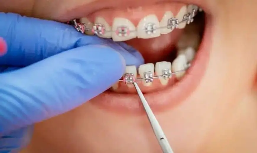 5 Things Your Orthodontist Wants You to Know About Maintaining Your Braces