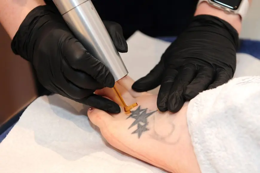 Choosing the Best Method for Tattoo Removal in Dubai