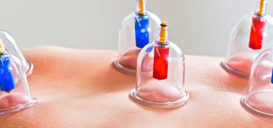 Hijama Cupping Therapy: Your Key to Ultimate Vitality