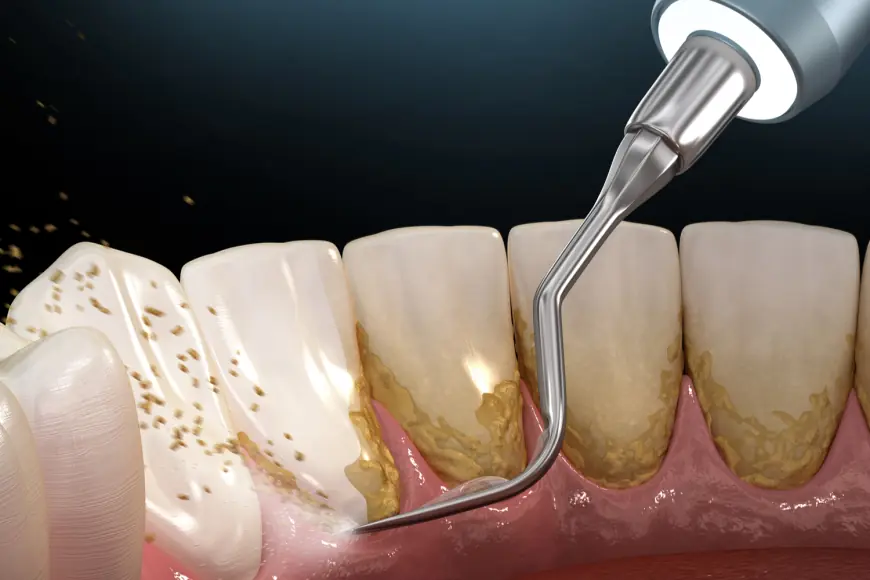 Scaling and Root Planing: Deep Cleaning for Healthy Gums