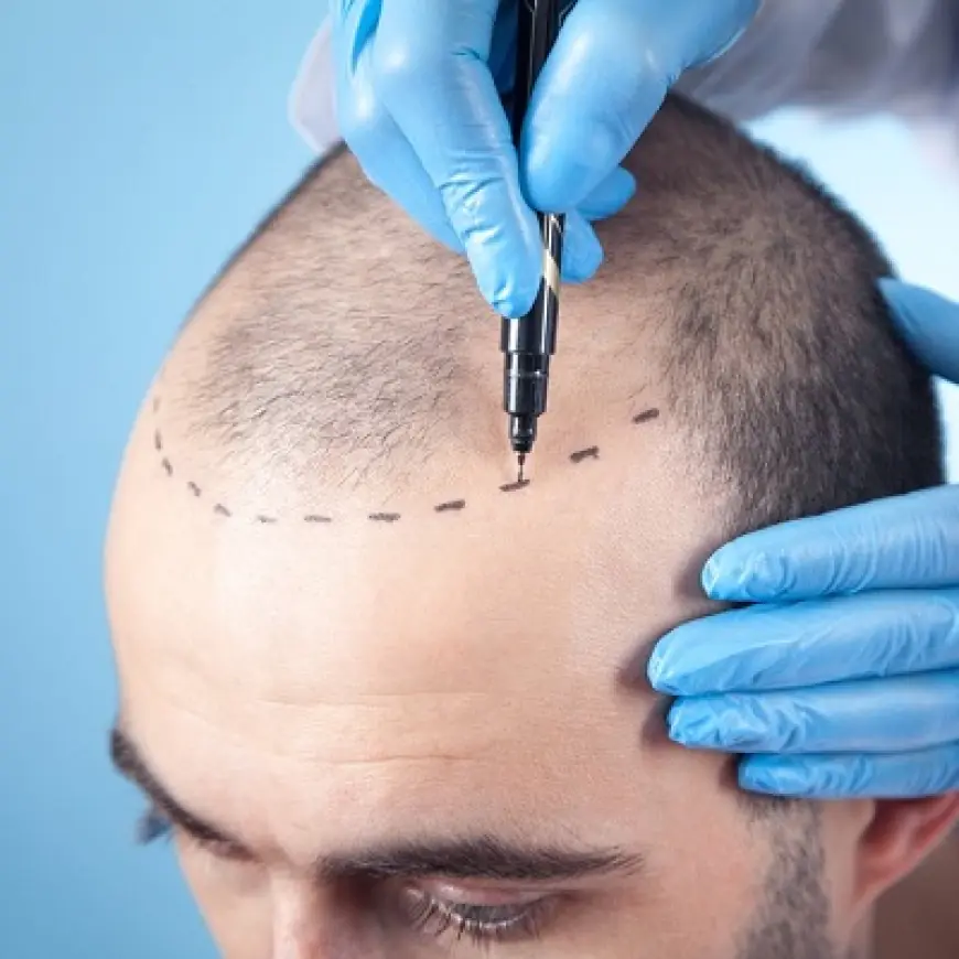 Hair Cloning: The Future of Hair Transplants?