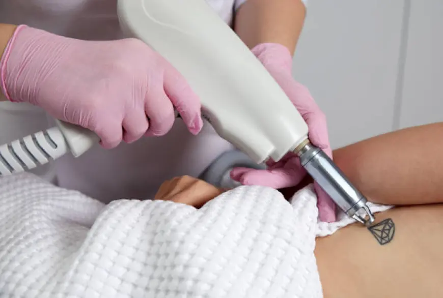 Understanding Pico Laser: The Top Choice for Tattoo Removal