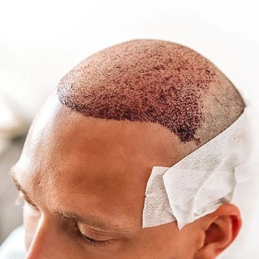 Are We Close to a Permanent Cure for Baldness?