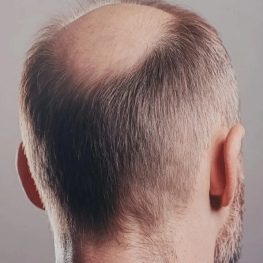 Common Myths About Crown Hair Transplant Debunked