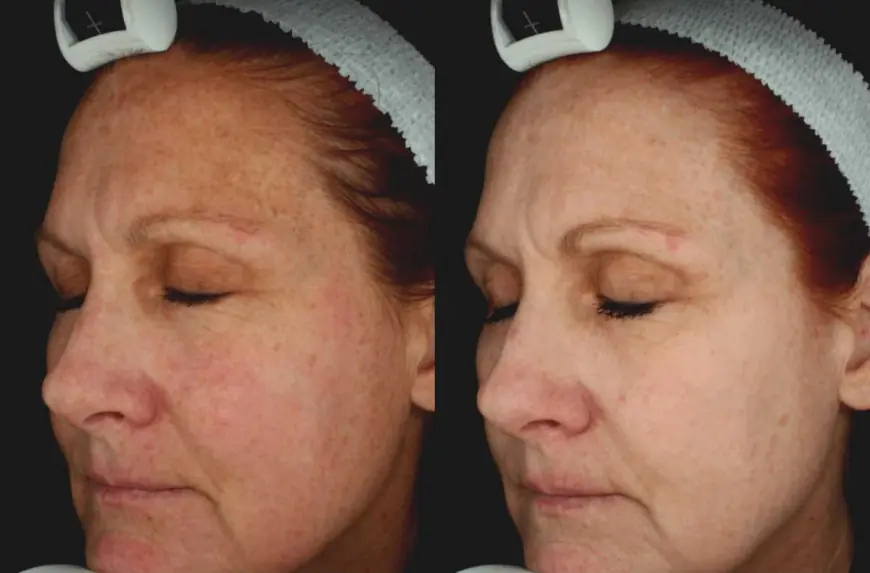 Is Pico Laser Treatment the Key to Reversing Skin Damage?