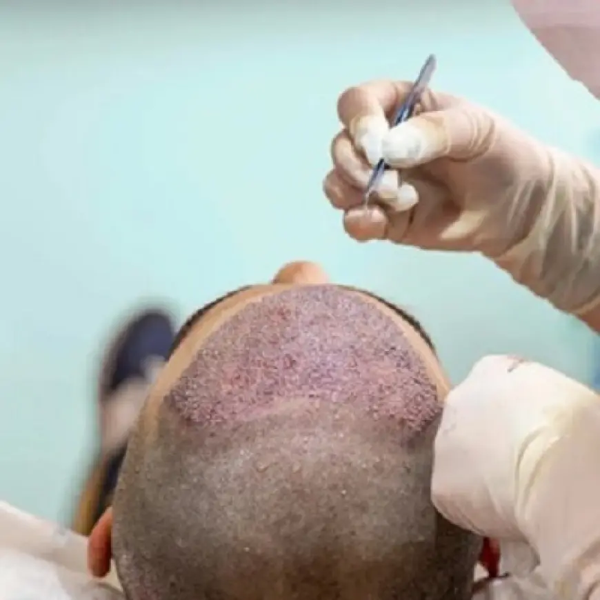 The Ultimate Guide to Hair Transplant: Everything You Need to Know