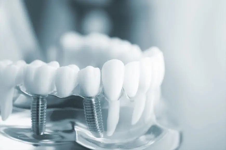 No More Waiting: The Rise of Same-Day Dental Implants