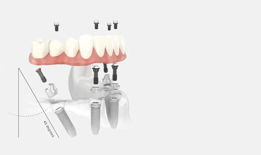 How Safe Are Same-Day Dental Implants? The Complete Guide