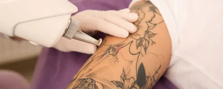 Tattoo Removal in Dubai: How to Choose a Qualified Specialist