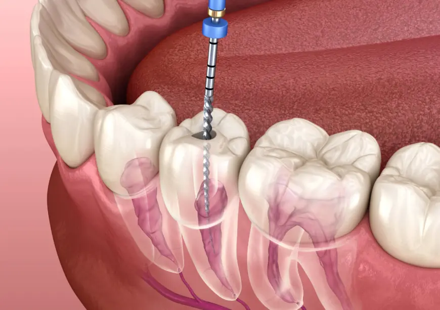 Endodontic Therapy: Procedure, Benefits & Recovery