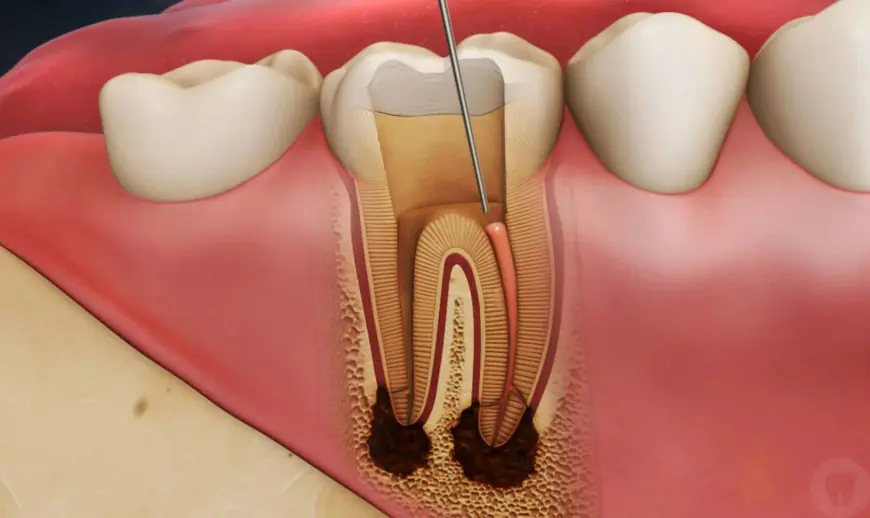 Tooth Root Canal Treatment: Procedure, Costs & Benefits